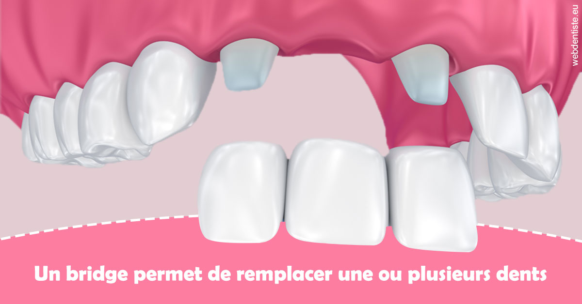 https://www.hygident-colin.fr/Bridge remplacer dents 2