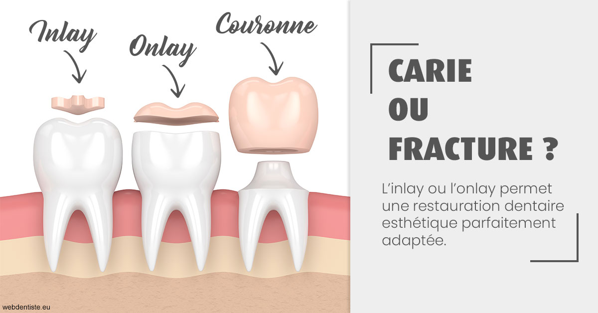 https://www.hygident-colin.fr/T2 2023 - Carie ou fracture 1