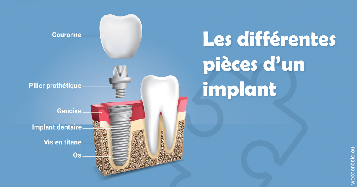 https://www.hygident-colin.fr/Les différentes pièces d’un implant 1